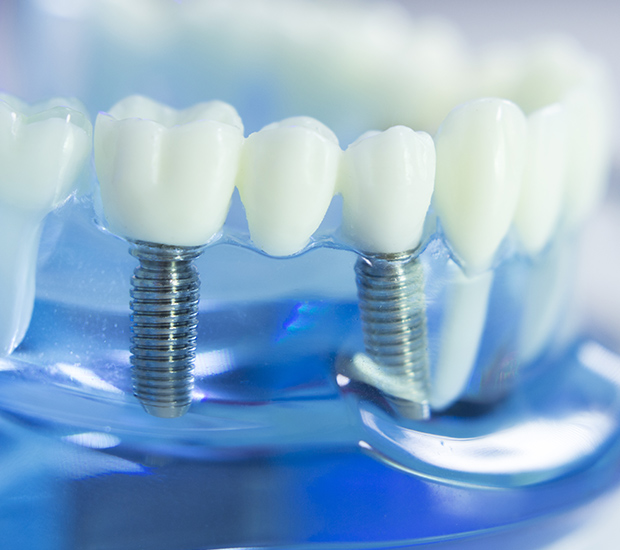 Sonoma Dental Implants