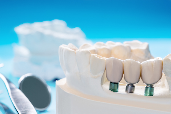 How Easy Is It To Replace An Implant Crown?