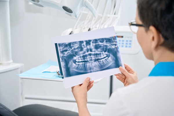 Reasons To Consider A Root Canal